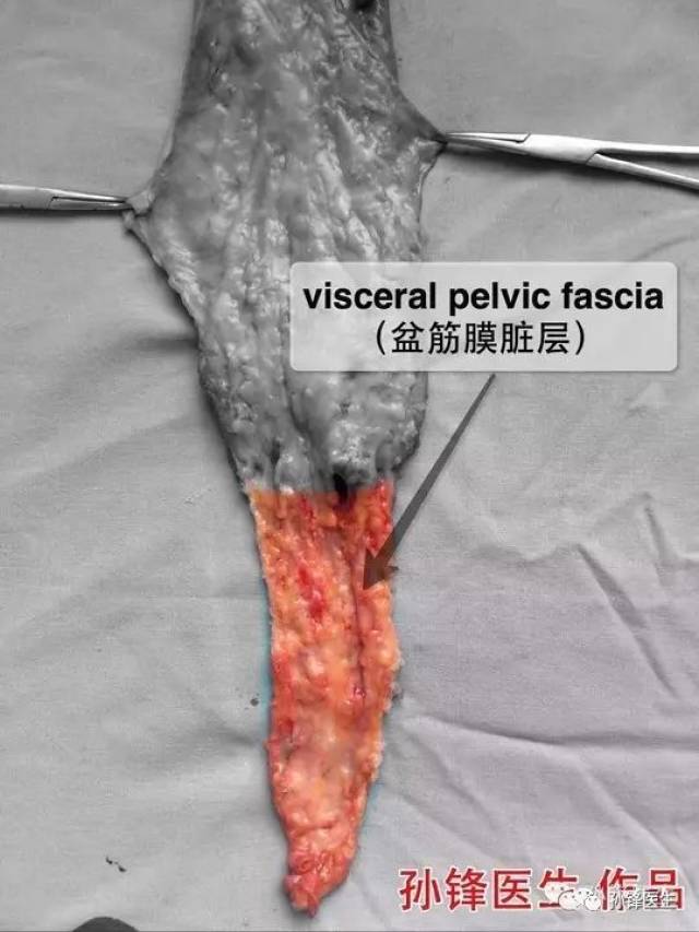 其实再讲的直白一点,直肠系膜就是指盆筋膜脏层(或者:直肠固有筋膜)包