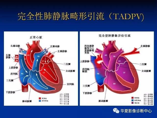 【影像基础】肺静脉畸形引流影像学诊断