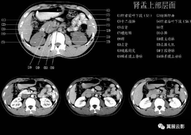 正常肝脏ct解剖