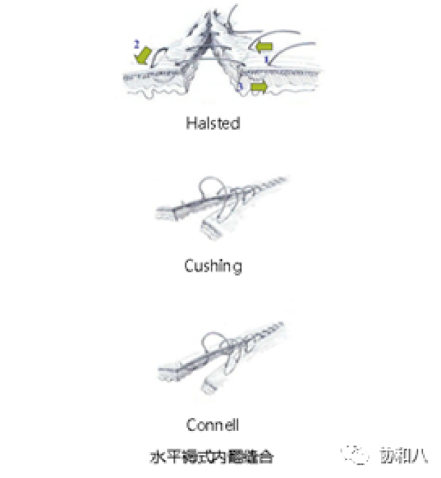 3)连续全层水平褥式内翻缝合:又称康乃尔(connell)缝合,在缝合时缝针