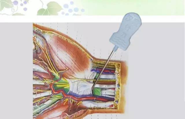 针刀治疗腕管综合征(图文详解)!
