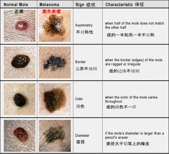 手掌和脚掌的色素痣容易发生癌变吗?_手机搜狐网