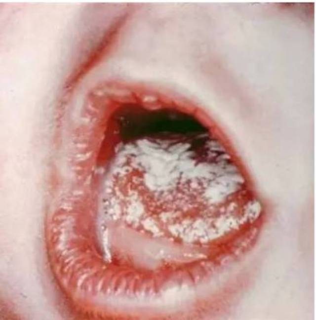 拿什么拯救你我的鹅口疮