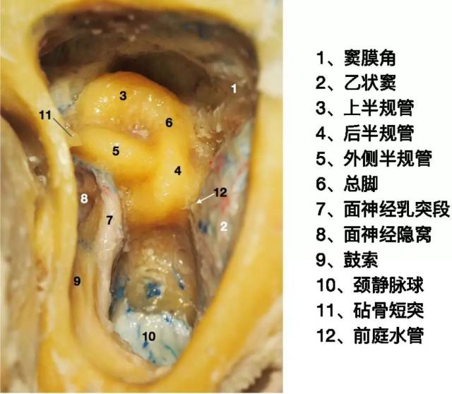 鼓索 乙状窦前入路中半规管的显露 学员体会 协和医院颅底显微解剖