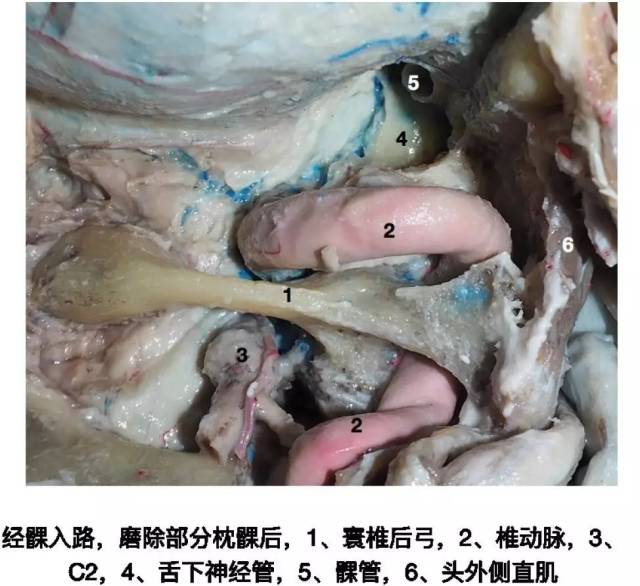 右侧 kawase 入路及相关解剖结构 1.耳蜗 2.膝状神经节 3.