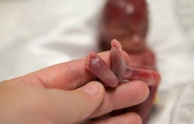 在我国,胎儿宫内死亡的定义为怀孕20周以后的胎儿死亡及分娩过程中的