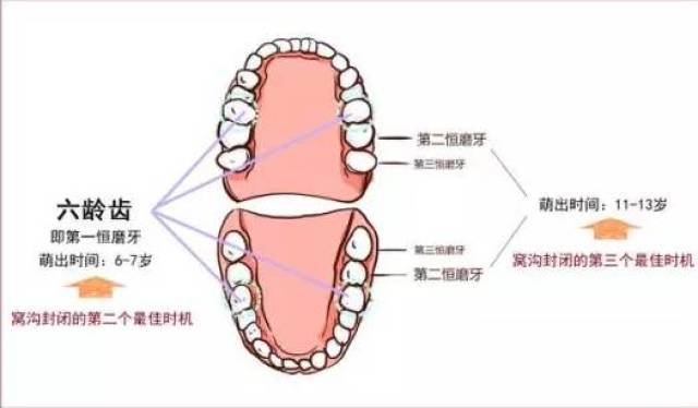 11-13岁时,第二恒磨牙萌出后 有蛀牙的牙齿能做窝沟封闭吗? 不可以.