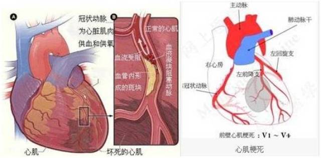 80岁老人心肌梗死突然晕厥,省中医院心血管病科成功救治