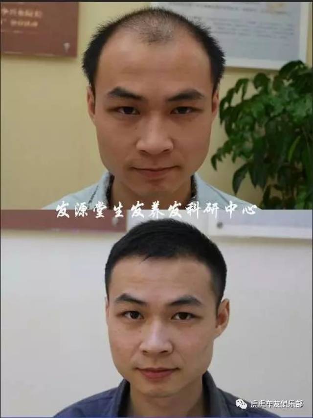 头发每天大把掉?脱发,秃顶,发际线后移,前额光秃看这里!