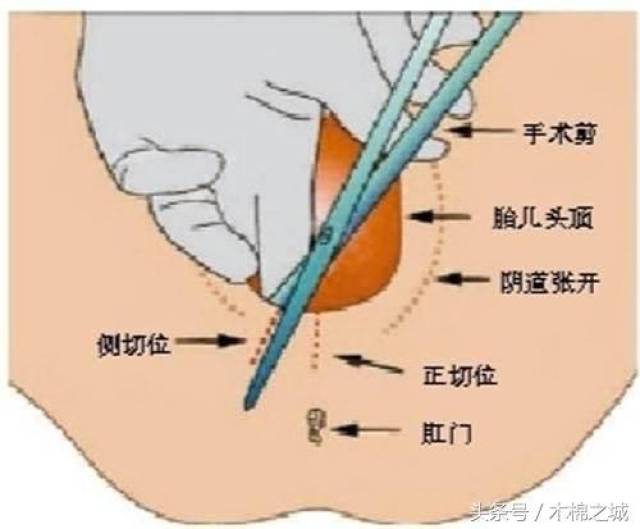 女人生孩子不容易,男人都会害怕,顺产下面也要剪一刀!