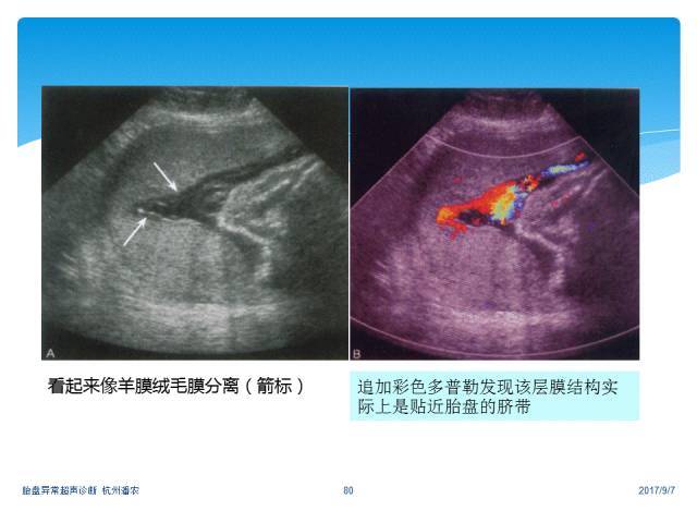 【超声微课堂】胎盘异常的超声诊断思路:羊膜腔异常回声光带