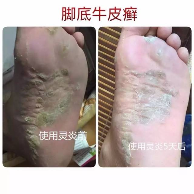 皮肤病,牛皮癣,湿疹,蚊虫叮咬怎么办?用这个方法试试看!