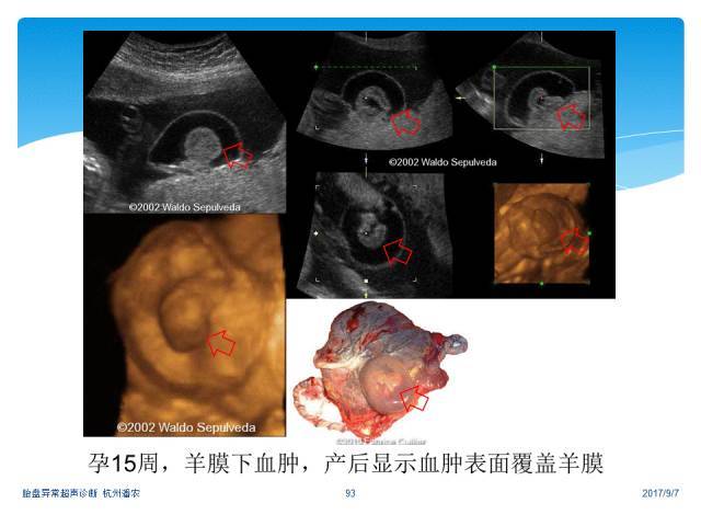 【超声微课堂】胎盘异常的超声诊断思路:羊膜腔异常回声光带