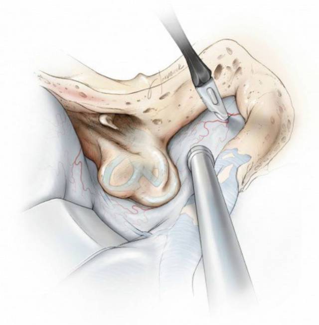 扩大经岩骨后入路手术技巧丨the neurosurgical atlas全文翻译