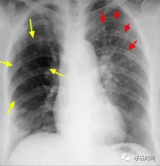 片示右中肺野血管纹理减少,密度减低(黄箭头);红箭所示为正常肺纹理.