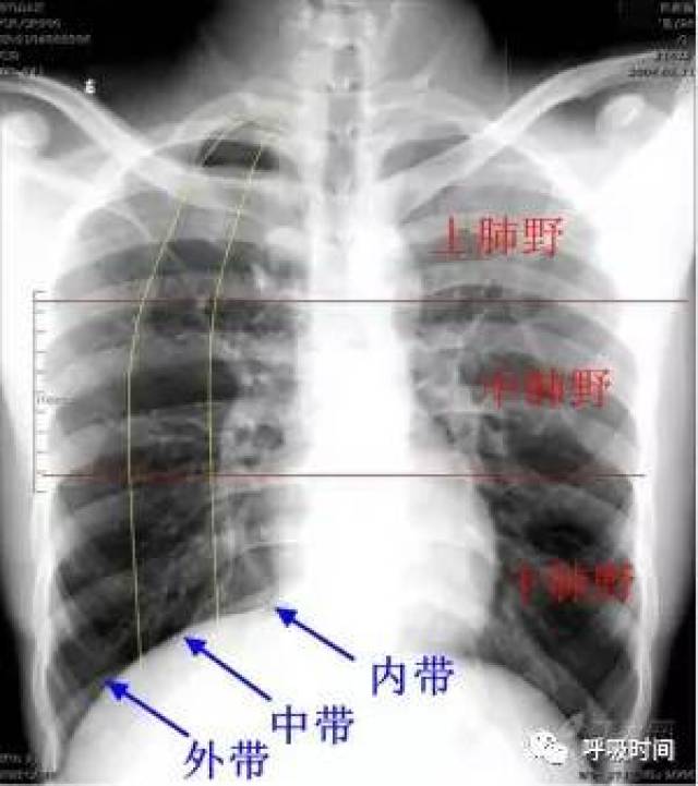 对 病变做出解剖定位,定量 图 4 将一侧肺野平均划分为上,中,下肺野