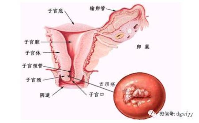 使宫颈充血,水肿,宫颈腺体和间质发生增生而导致宫颈不同程度的肥大