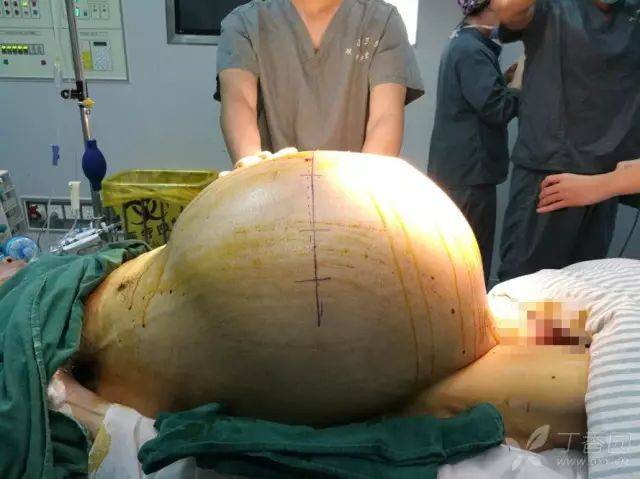 震撼!病人体重 70  kg,切下来的腹部肿瘤 40  kg