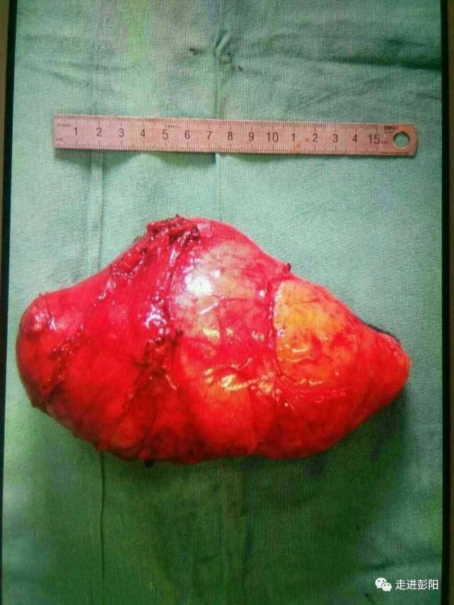成功取出重达1kg,12cmx10cmx10cm的肿瘤.