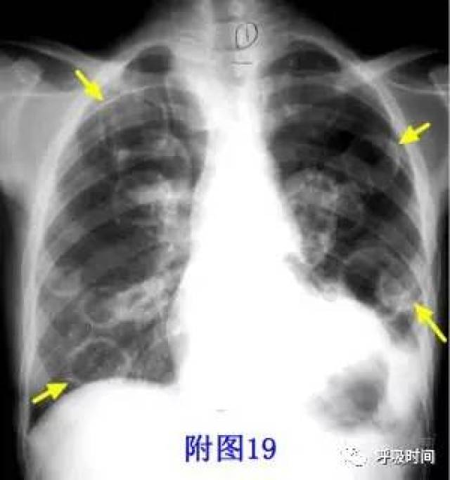 肺结核:右肺上叶多发空洞,内可见气液平;可见肺尖帽征