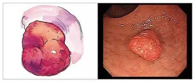 息肉有这几个种类,切不切除靠什么决定?