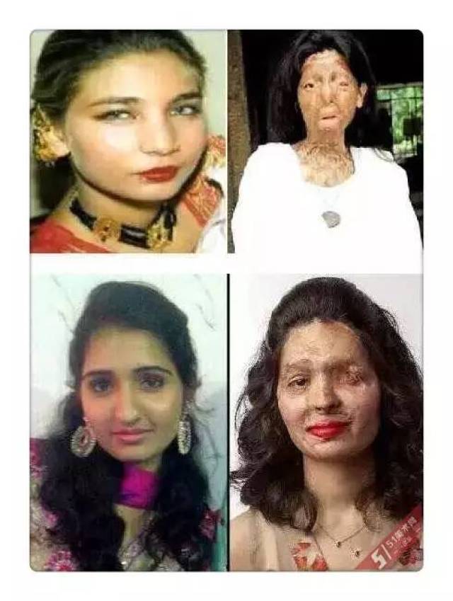 这些印度美女被泼硫酸毁容后,没有自杀,依然美丽的活着!