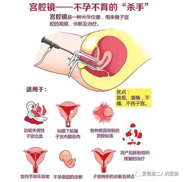 【二院新技术】妇科微创内窥镜之宫腔镜——"洞若观火