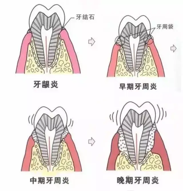 牙周袋溢脓时,可用1%～3%过氧化氢液冲洗,袋内置10%碘合剂或螺旋霉素