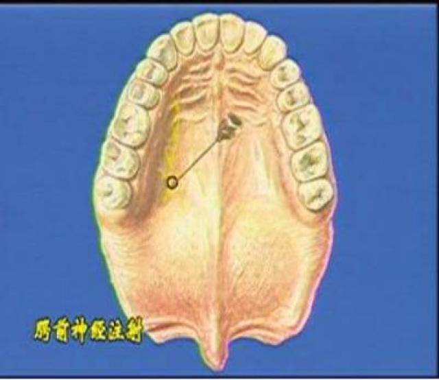 3,鼻腭神经阻滞麻醉(切牙孔注射法)