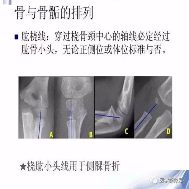 儿童肘关节骨折的x线诊断丨影像天地
