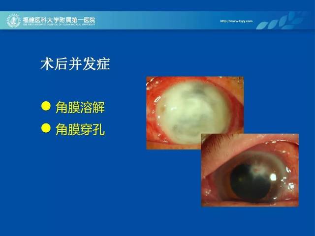ccos2017丨胡建章副教授谈真菌性角膜炎治疗体会