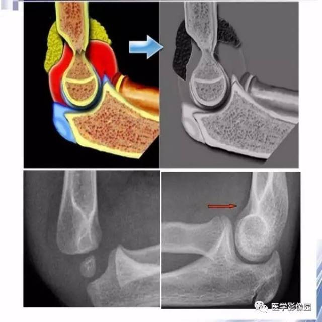 儿童肘关节骨折的x线诊断丨影像天地