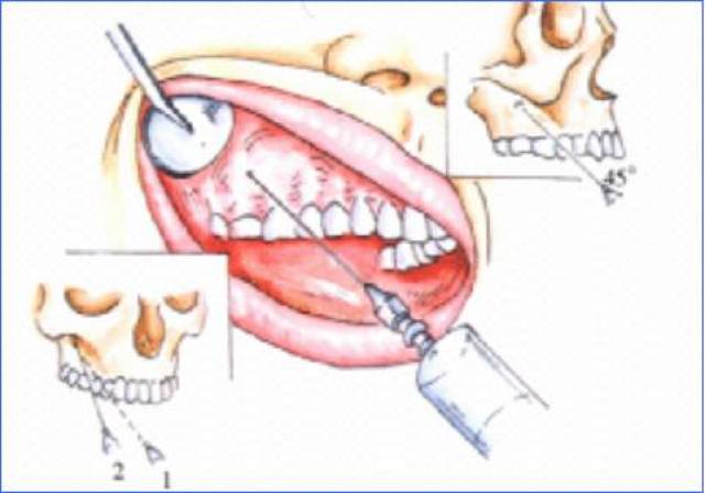 1,上牙槽后神经阻滞麻醉(上颌结节注射法) 适用症:上颌骨后部手术及