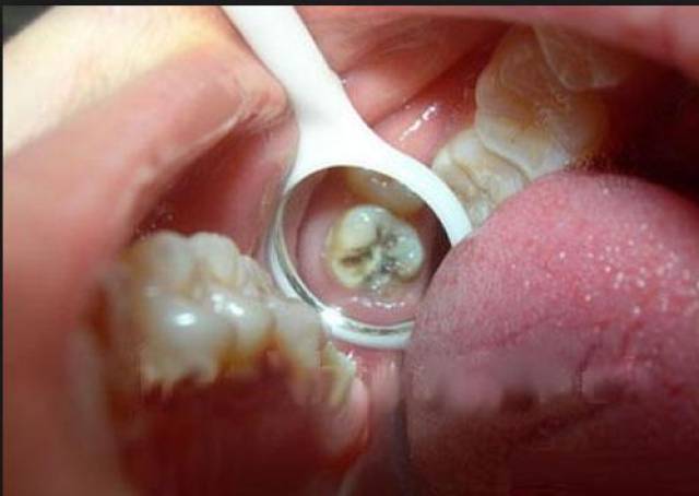 抽牙神经的真相 究竟为什么要在牙齿上开个洞?