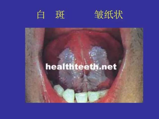 多图连载(三):口腔黏膜斑纹类疾病及变态反应性疾病图示