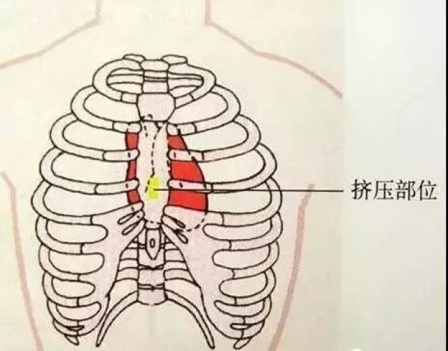 4 部位要准确 按压部位在胸骨下1/3交界处或双乳头连线中点.