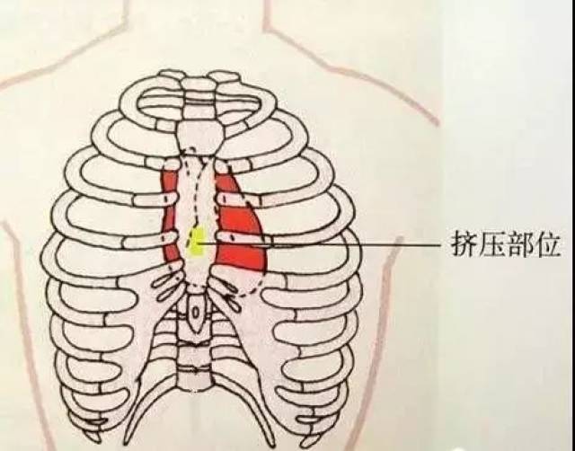 胸外心脏按压,这10点细节要注意 !