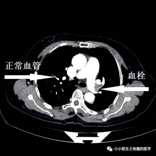 左肺动脉血栓.