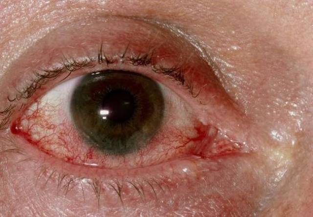 眼睛一出现4种情况,表明肝已受损,警惕是肝癌早期信号