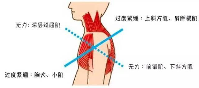 圆肩驼背是气质杀手,你中招了吗?