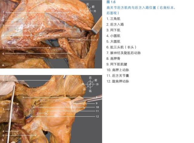 多图|肩关节镜手术盂肱关节后方入路解剖要点