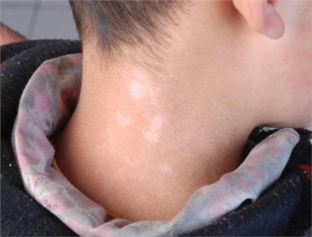 白色糠疹则常发于面部,亦可见于上臂,颈,肩部等部位.