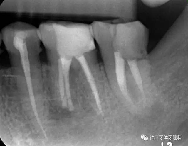 术后8个月根尖周牙槽骨修复及根周膜开始形成