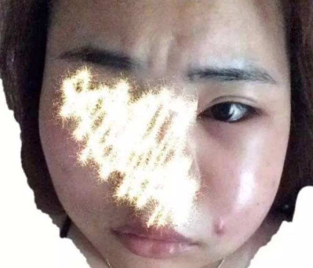 (正常时候的脸) 医生说是感染了,危险三角区的痘痘不要挤 挤了就有