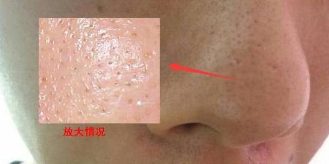 脸上能挤出黄颗粒的小黑点,是螨虫还是护肤品作怪?