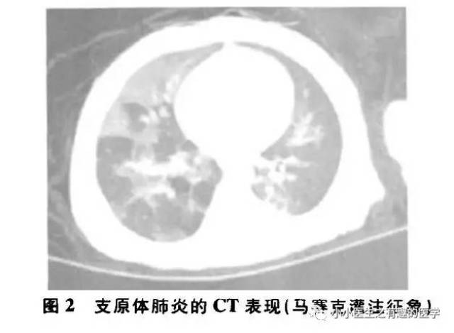 肺栓塞提高篇:ct平扫可发现,甚至诊断肺栓塞,看看国外