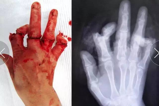 手指创伤性断裂是外科急症,不恰当处理易导致严重后果.