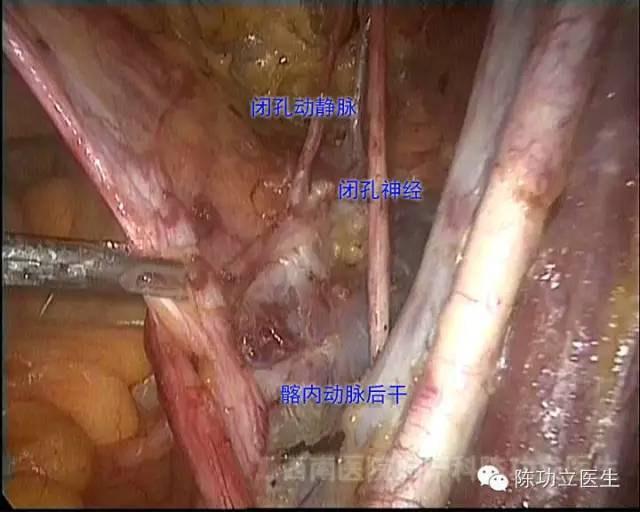 15张妇产科「手术解剖图谱」!