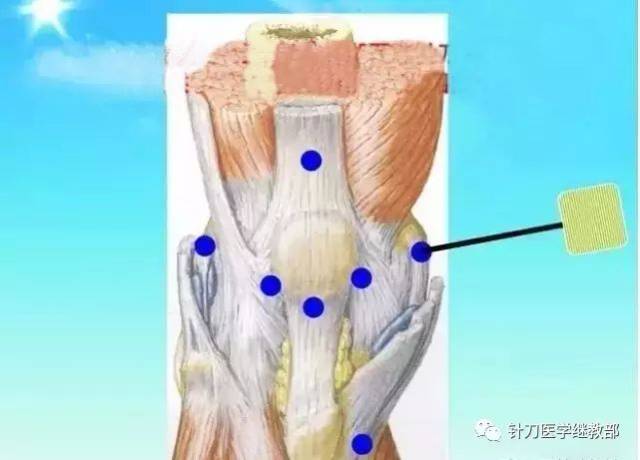 1)第1支针刀松解胫侧副韧带的粘连和瘢痕 刀口线与下肢纵轴方向一致