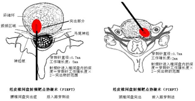 治疗腰椎间盘突出的十个方法,你知道多少?